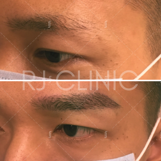 Male Before after results of instabrow eyebrow transplant