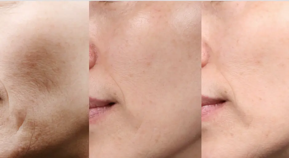 Before and after Potenza RF microneedling for acne scars and overall skin smoothing