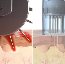dermapen_vs_dermaroller.jpg