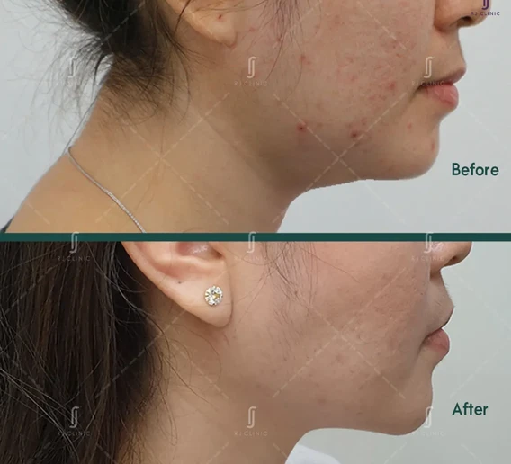 Before and after female face slimming with Acculift face lipo at RJ Clinic