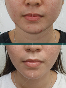 Acculift Face Slimming Laser Lipolysis Before After Results | RJ CLINIC