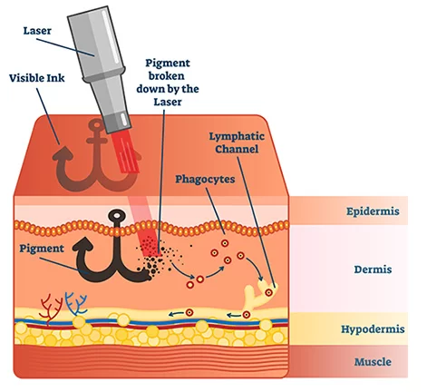 How Laser Tattoo Removal Works | RJ CLINIC