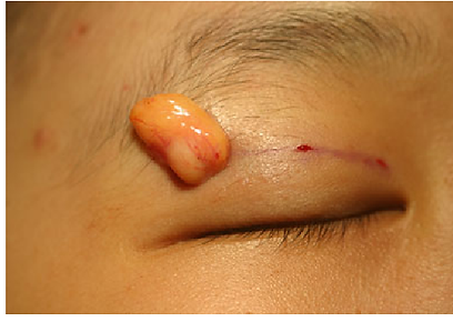 Eyelid Fat Removal | RJ CLINIC