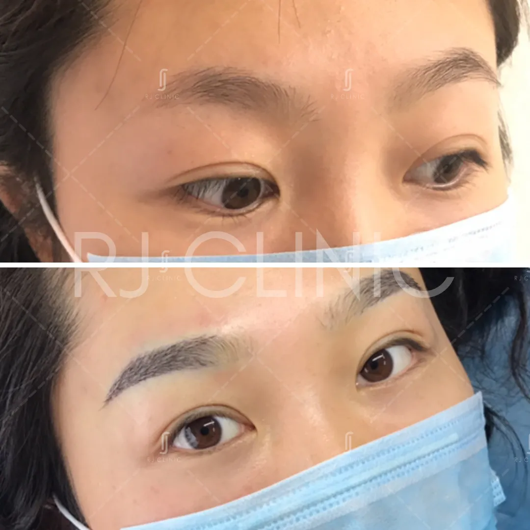 Before after results of instabrow eyebrow transplant