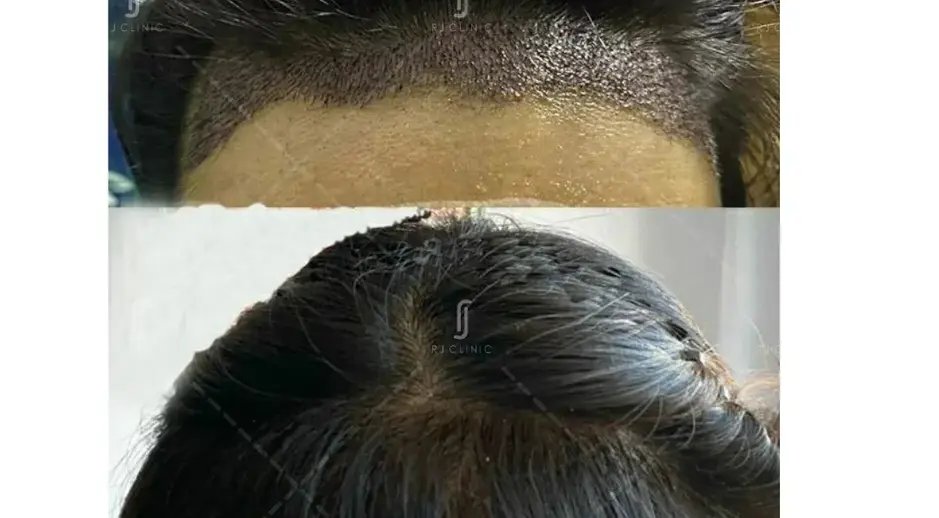 Natural hairline outcome after FUE hair transplant treatment