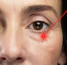 non-surgical laser eyebag removal