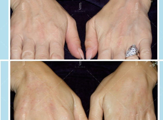 Hand Rejuvenation Treatment by RJ AESTHETIC CLINIC (5).jpg