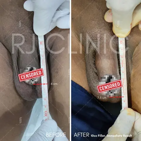 Penile filler treatment result showing natural-looking enlargement