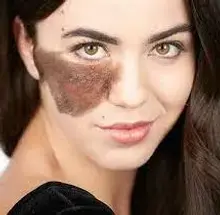 birthmark-aesthetic-treatment.webp