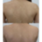 Acne Treatment done at RJ AESTHETIC CLINIC (2)