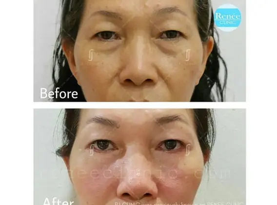 Combined double eyelid and eye bag removal surgery
