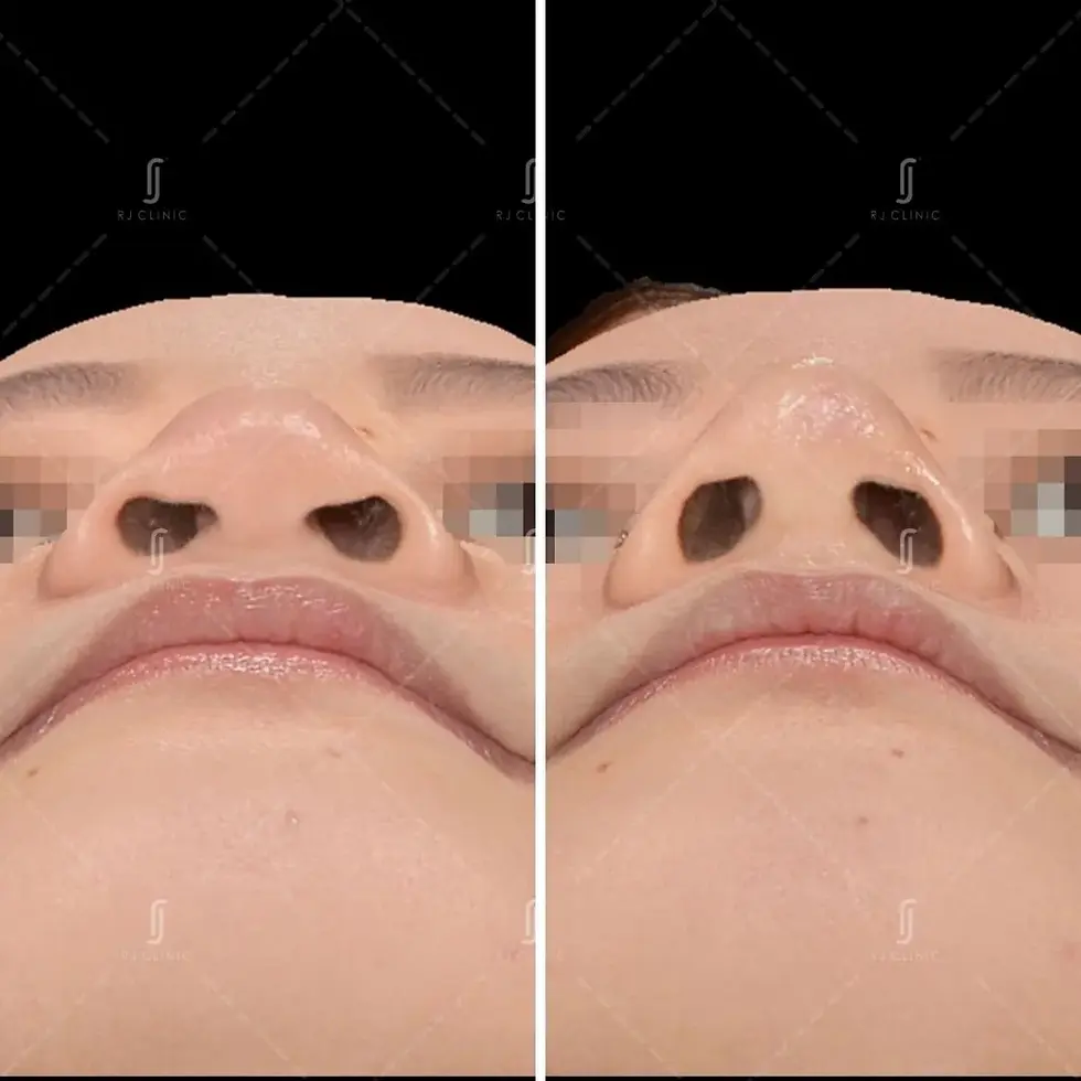 RJ Clinic nose tip correction with combination nose filler and thread