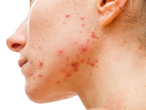 acne and acne scars on the face