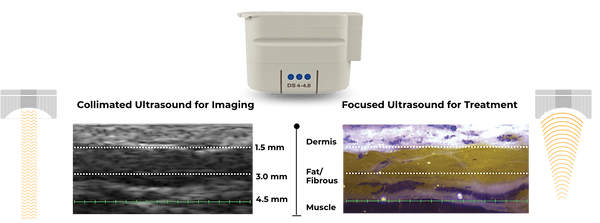 deepsea technology of ultherapy ultrasound