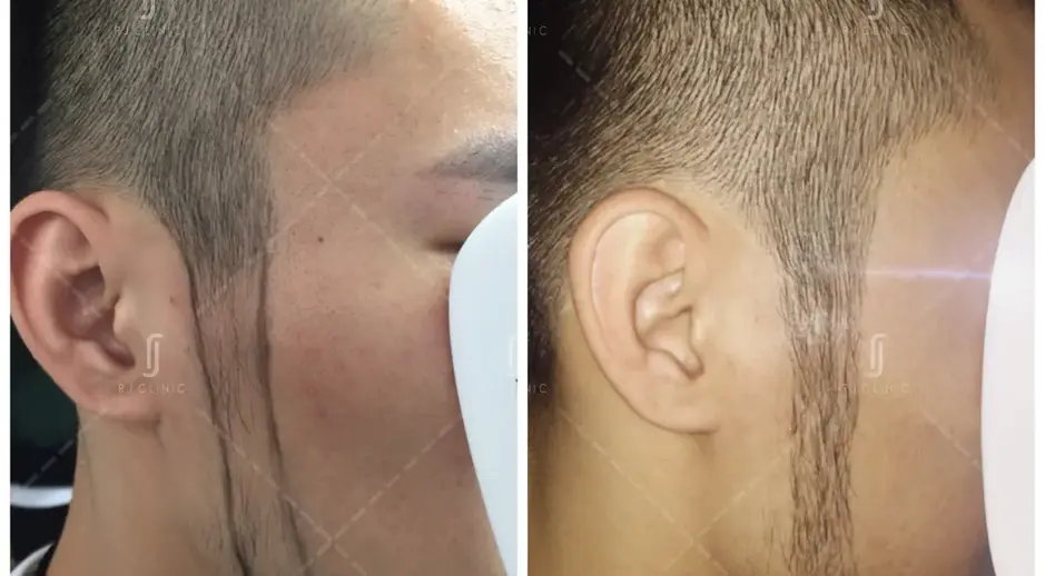 Male hairline recession before and after FUE hair transplant procedure
