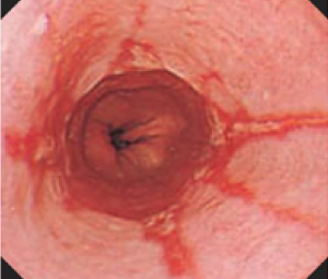 くし状のただれを認める逆流性食道炎