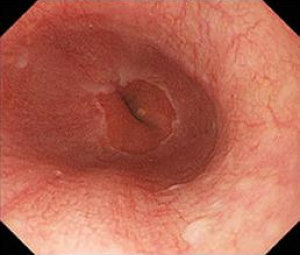 正常な食道粘膜