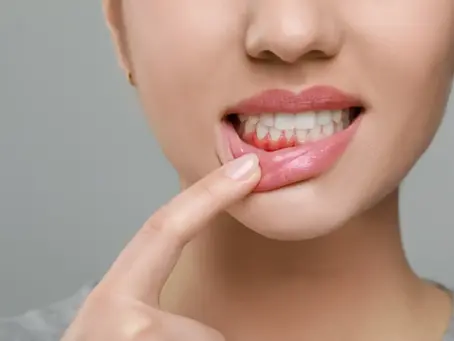 How Preventative Care Stops Gum Disease Before It Starts