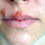 Thumbnail: HERPES