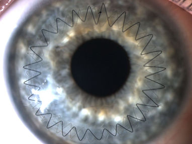 Keratoplasty Training