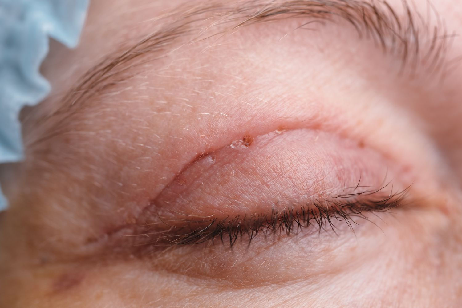Blepharoplasty Training