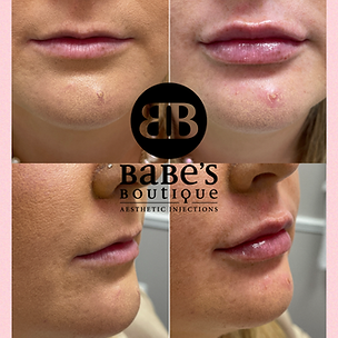 Lip Fillers