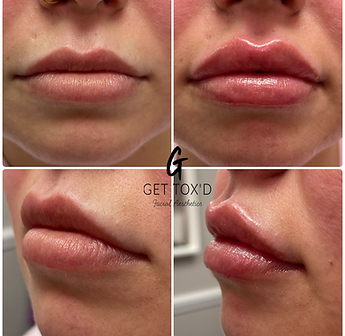 Lip Fillers