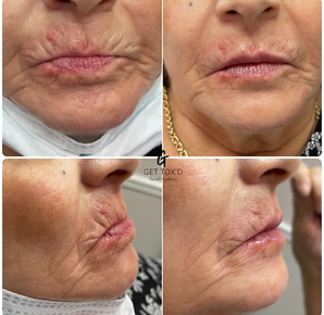 Nasolabial fold filler before and after showing softened smile lines and improved facial contour