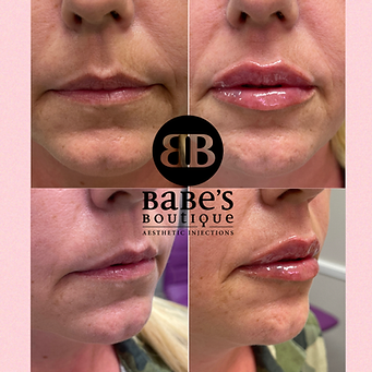 Lip Fillers