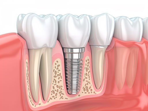 How Long Do Dental Implants Last?