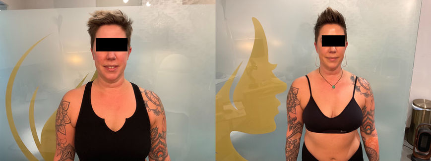 Semaglutide Weight Loss