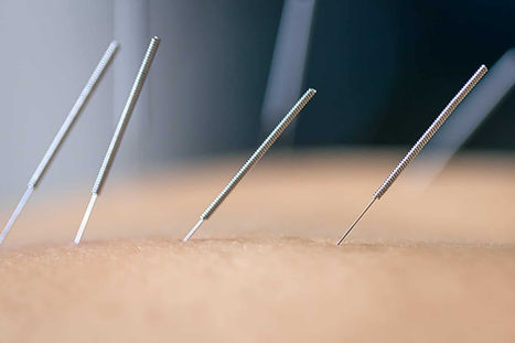 Dry-Needling-back-Pain.jpg