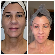 Before and After Plasma Pen