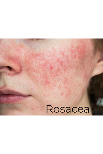 A close up of a lady with red cheeks and nose
