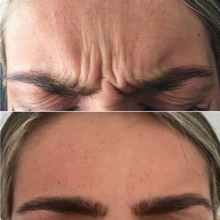 Anti-wrinkle treatments by Dr.Ranjbar (L1p cosmetics)