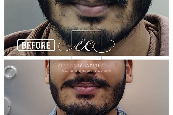 Dermal Fillers