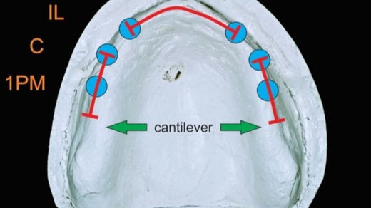 A prótese fixa sobre implantes: decisões sobre esplintagem & cantiléver. Foto: arquivo pessoal.