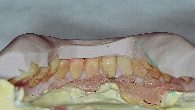 Muralha de silicone: uma bússola na construção da prótese dentária. Foto: arquivo pessoal.