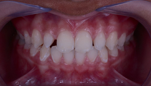 Aspecto clínico inicial intrabucal. Procedimentos Clínicos com IA na Odontologia. Capítulo 10. IA na Prótese Dentária. Santos Publicações Ltda. Todos os direitos reservados.