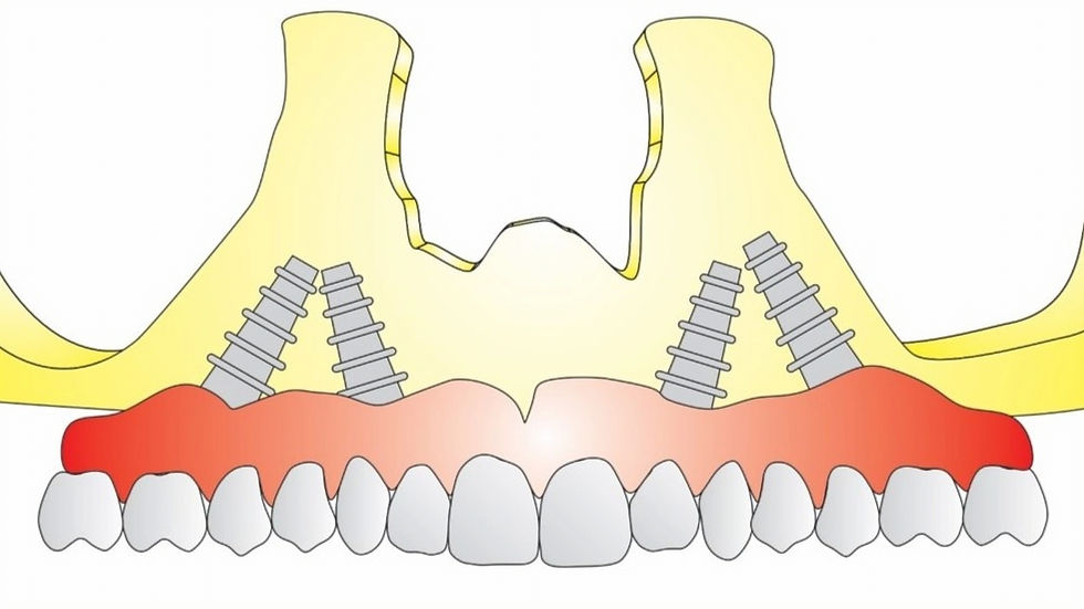 O rebordo maxilar edêntulo: opções de prótese e implantes