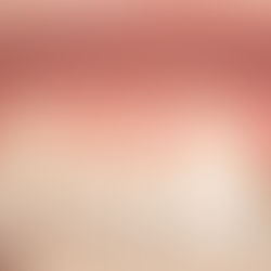 A agenesia dos incisivos laterais: cuidados na inserção dos implantes dentários.