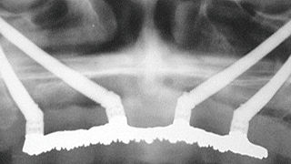 Representação esquemática de uma maxila atrófica recebendo quatro implantes zigomáticos