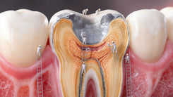 Lesão endo-periodontal: o fluxo do diagnóstico e tratamento mais recente.