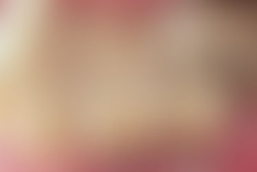 Prótese parcial fixa sobre implantes. Fonte: arquivo pessoal.