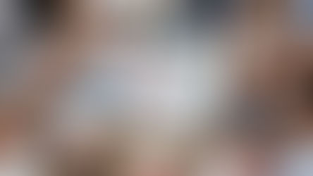 Implantes dentários: o que é consenso na maxila edêntula?