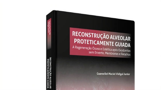Reconstrução Alveolar Proteticamente Guiada. Foto: Santos Publicações Ltda.