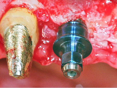 O tratamento com implantes dentários e as redes sociais