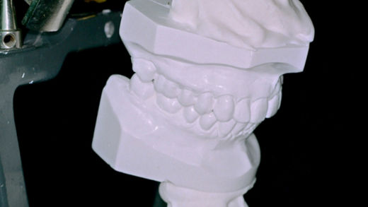 Doze passos para dominar seu articulador semiajustável