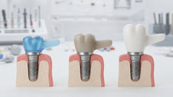 Três coroas unitárias sobre implantes com alturas diferentes e cantilever fixo.