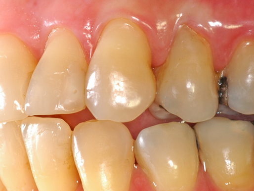 Esquemas oclusais em prótese fixa: existe um melhor do que o outro?